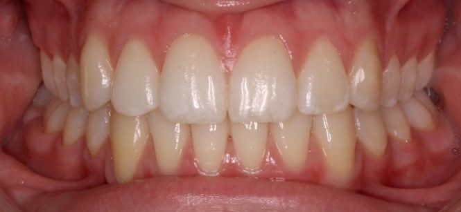 ABozik-Final(09-17-2013)-Intraoral anterior