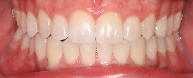 12-245-jeremy-peacock-final-ii02-28-2014-intraoral-anterior