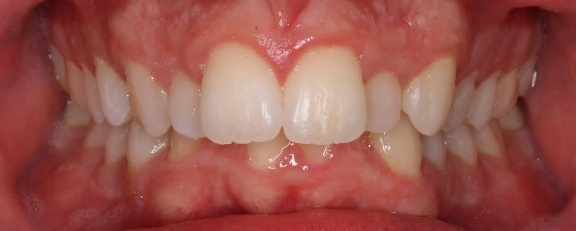 12-245-jeremy-peacock-initial04-27-2012-intraoral-anterior