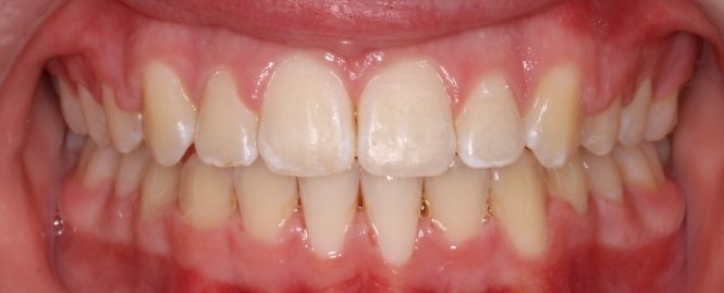 lharrison-final12-19-2013-intraoral-anterior