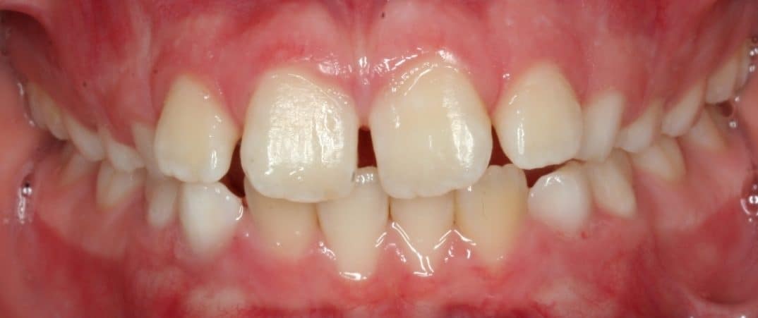 lharrison-initial09-07-2011-intraoral-anterior