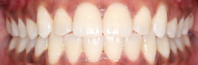 Crowding teeth after invisialign