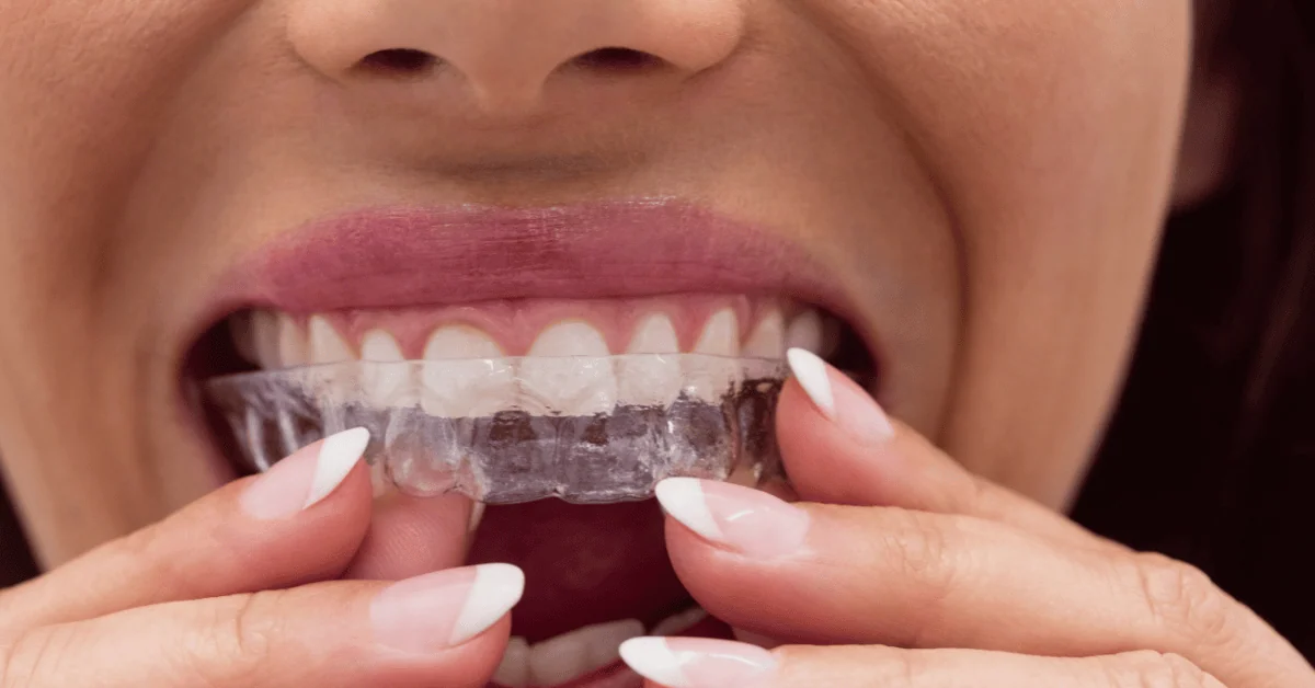How to Keep Your Teeth Looking Their Best After Orthodontic Treatment